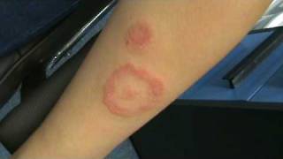 SCARY RINGWORM ON GIRLS ARM [upl. by Knuth243]