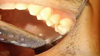 Metal Crown Preparation on Patient  1st Molar Crown Preparation [upl. by Einneg249]