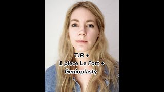 2 Week Postop Update TJR  1 piece Le Fort  Genioplasty [upl. by Keyser]