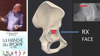 Comment lire une radio de hanche les 3 types de coxarthrose Extraits Dr Baur journée SMATSH [upl. by Boigie136]