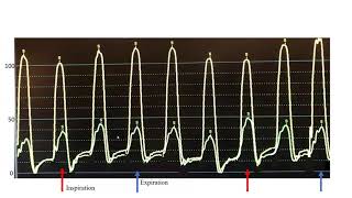 Hemodynamics Constrictive pericarditis cases mechanisms technical tips Elias Hanna Univ of Iowa [upl. by Jasmin]