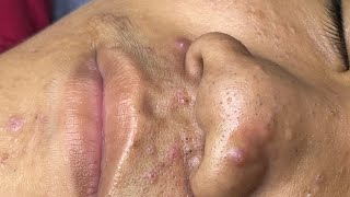 ACNE TREATMENT VU QUYNH MI Acne On Boys Nose 2024 [upl. by Oringas]