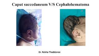 Caput Succedaneum vs Cephalohematoma  Pediatrics [upl. by Isabella]