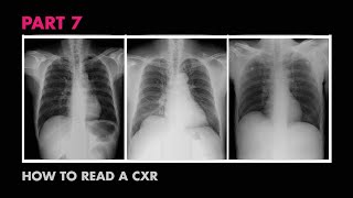 Cardiac Silhouette  How to Read a Chest XRay Part 7  MEDZCOOL [upl. by Aramak]