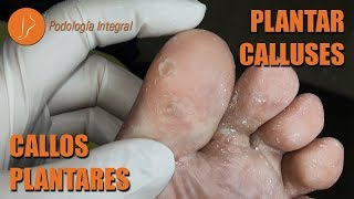 Plantar calluses Podología Integral podologiaintegral [upl. by Dian453]