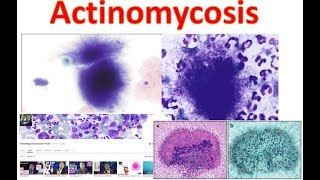 Actinomycosis Medschooltutorial [upl. by Haden40]