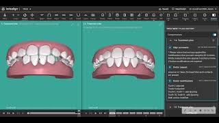 Excellent Invisalign First Result with ARCH expansion but not SKELETAL expansion [upl. by Dana]