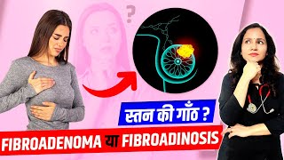 Fibroadenoma vs Fibroadenosis  Benign Breast Diseases  Breast में Lump । स्तन मे गाँठ [upl. by Theron]