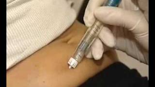 How correctly use multidose GONAL  F injection [upl. by Tap]