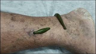 leech therapy for skin problemsleeching leechtherapy skinproblems [upl. by Hanah]