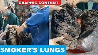 Doctors show a chain smoker’s donated lungs the condition will shock you [upl. by Kcirdnekel]