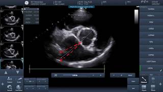 Video 1  How to perform basic echocardiographic measurements  LAAo [upl. by Florenza854]