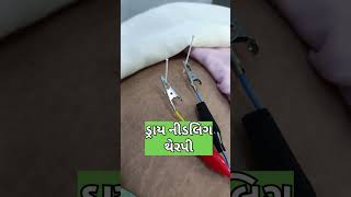 Dry needling Therapy Glute pain Instant Pain relief Dr Mittals Rehab [upl. by Mcintyre]