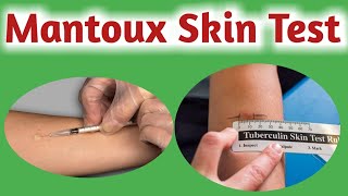 Mantoux test  Tuberculin skin test  Tuberculin test [upl. by Attela964]