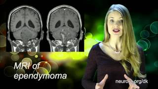 Ependymoma [upl. by Toback]