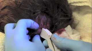 scalp laceration fixed with staples [upl. by Gusba]