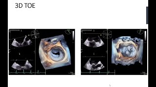 Transcatheter mitral valve leaflet repair with PASCAL system the role of echocardiography [upl. by Gnahc]