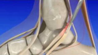 Introduction to Posterior Tibial Tendon Dysfunction [upl. by Kurman]