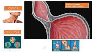 POEM tratamiento ACALASIA [upl. by Gelhar]