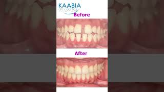 Bimaxillary protrusion  open bite and diastema [upl. by Atinrahc51]