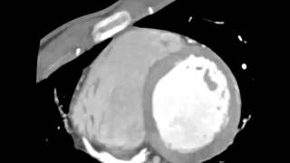 Multiple Giant Coronary Artery Aneurysms Due to Kawasaki Disease ElectrocardiogramGated 64Slice [upl. by Gomer]