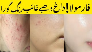 Blackheads removal cream  Urgent control acne cream  acne treatment [upl. by Leonardo]