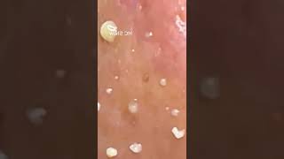 Pickel Ausdrücken Blackheads Akne amp Mitesser entfernen 🔴 27 [upl. by Chaddie]