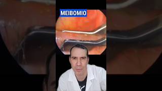 Disfuncion de la Glándula de MEIBOMIO oftalmologia glandulas meibomianglanddysfunction parpados [upl. by Hama]