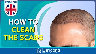 How to clean the scabs after 11 days from the hair transplant operation [upl. by Assirac144]