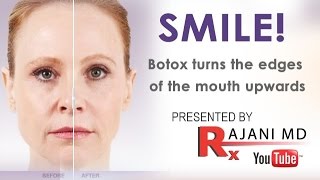 SMILEBotox Injected to Turn the Mouth UpwardsRajaniPortland [upl. by Bee72]