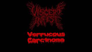 Verrucous Carcinoma Stage IV  Viscera infest [upl. by Figge]