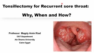 Tonsillectomy for Recurrent sore throat Why When and How [upl. by Izmar]