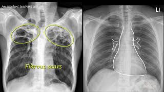 Chest x ray  Tuberculosis healed TB Inactive TB [upl. by Serrell]