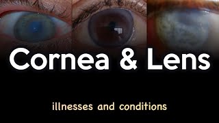 Cornea and Lens Illnesses and Conditions [upl. by Canute]