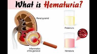 Haematuria Red urine mrcpch Clinical [upl. by Christiano299]