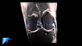 How to Read Knee MRI of Normal Knee  Anatomy of the Knee  Complex Knee Surgeon  Minneapolis  MN [upl. by Brad]