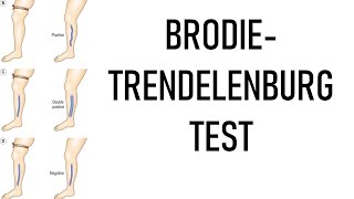 BrodieTrendelenburg Test examination of varicose veins [upl. by Ahsitra]