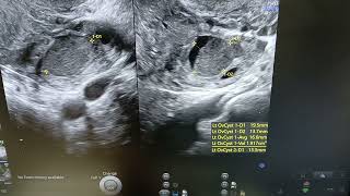 Endometrioma  Hemorrhagic Cyst  Ultrasound [upl. by Leuas]