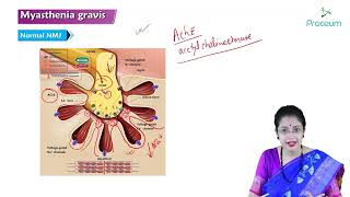 Myasthenia Gravis Part 1 Hindi  Internal Medicine [upl. by Leugim224]