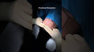 FOREHEAD REDUCTION 💆🏻‍♀️ Dr Ahmet Dilber 🪄 foreheadreduction plasticsurgery forehead [upl. by Liew168]