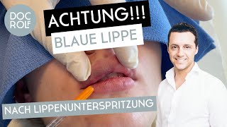 BLAUE LIPPE nach LIPPENUNTERSPRITZUNG Dr Rolf Bartsch [upl. by Etterual]