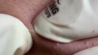 Acne Treatment Huong Da Nang  2024 blackheads 711 [upl. by Madlin]