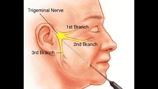 Trigeminal Neuralgia [upl. by Allerie270]