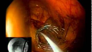 Large Bowel Obstruction Colonic Stent [upl. by Ezaria]