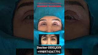 Qovoq olish  қовоқ олиш  blefaroplastika Doctor ODILJON 998974347791 TOSHKENT VA JIZZAXDA rek [upl. by Anees]