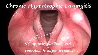 Laryngology  Chronic Hypertrophic Laryngitis [upl. by Lzeil]