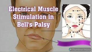 Bells Palsy treatment Electrical Muscle Stimulator in Bells Palsy [upl. by Lavud]