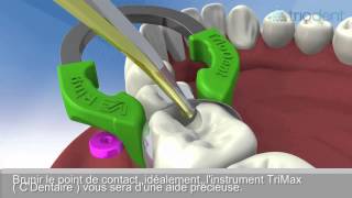 TRIODENT V3 SYSTEME MATRICE PROTOCOLE [upl. by Danuloff687]