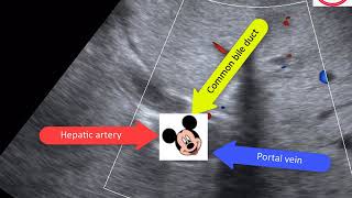 Hepatobiliary ultrasound Two cases [upl. by Enileuqkcaj]