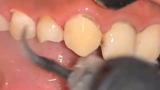 ASMR Teeth Cleaning  BEFOREAFTER Deep Dental Tartar amp Calculus Removal [upl. by Harlamert181]